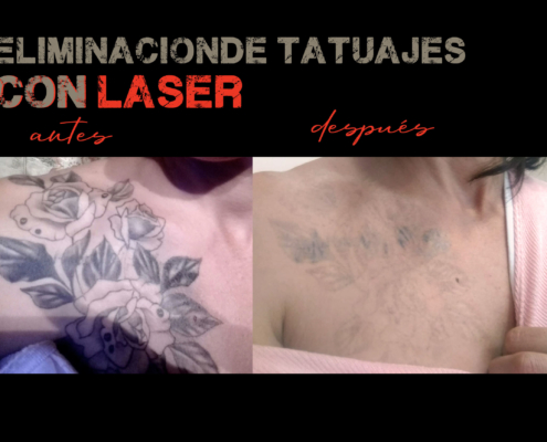 eliminacion de tatuajes con laser valencia