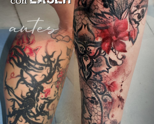 tatuajes cover up eliminacion con laser valencia