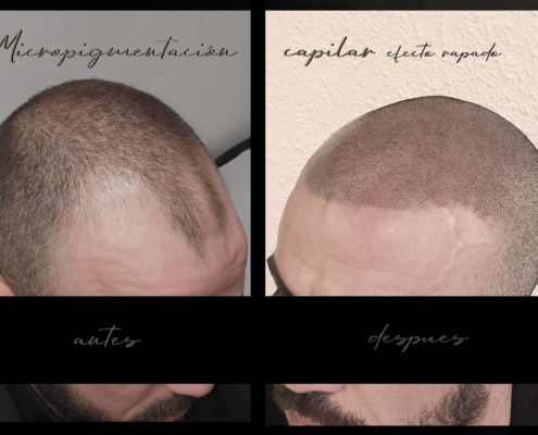 micropigmentación capilar antes y después
