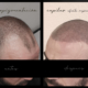 micropigmentación capilar antes y después