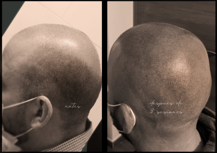 capilar tratamiento de micropigmentacion en valencia efecto rapado tatuar pelo