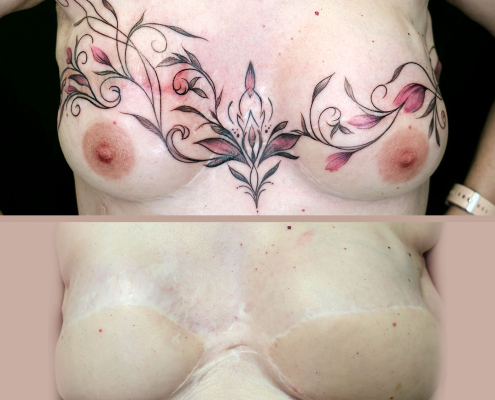 tattoo tatuaje terapeutico para mujeres postcancer reconstruccion de areolas y cicatrices en valencia 1