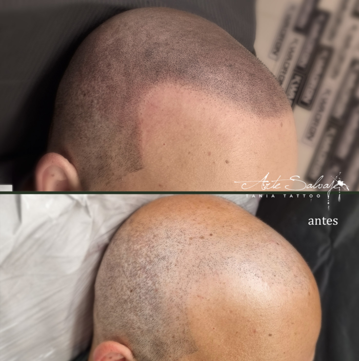 capilar micropigmentacion efecto densidad rapado afeitado en valencia tatuar pelo para mujeres y hombres 4