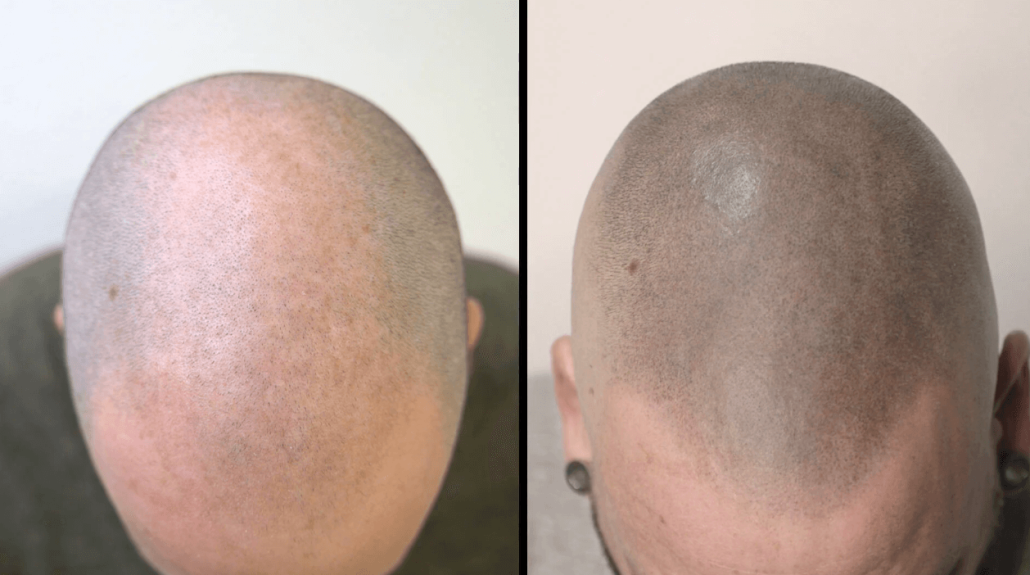 experiencia antes y después micropigmentación capilar
