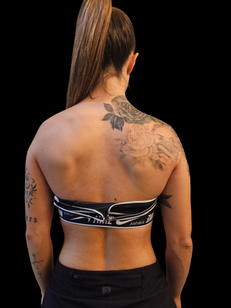 laser tatuaje cicatriz